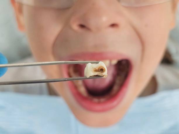 Best Emergency Dentist for Knocked-Out Tooth in Lton, IN